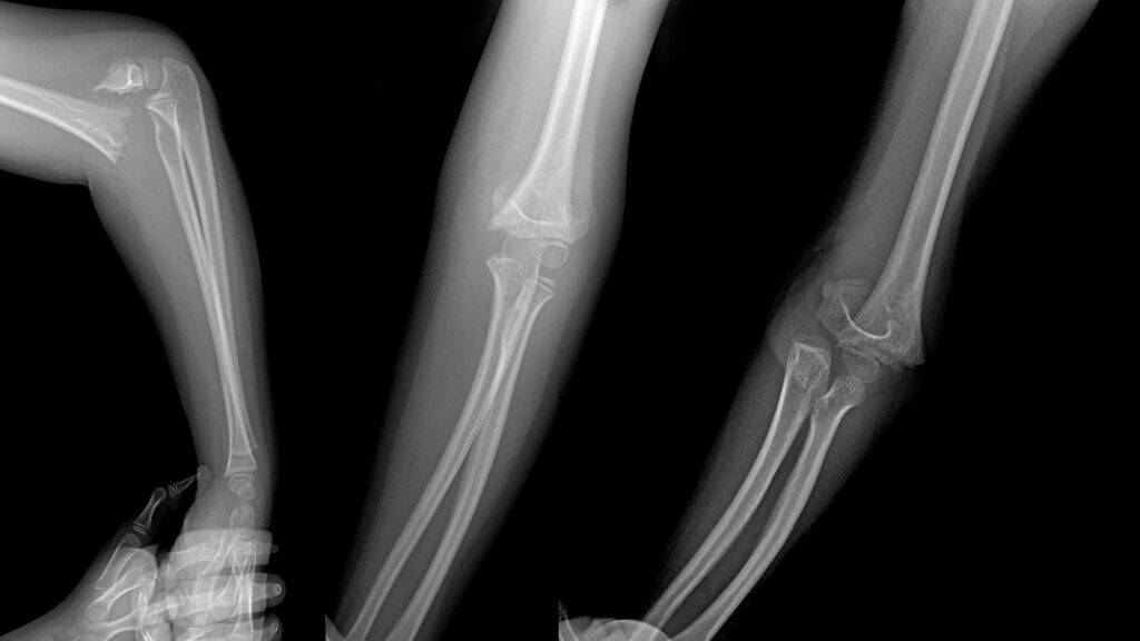 Multiple broken arm X-ray images showing fractures for broken arm compensation calculator UK assessment
