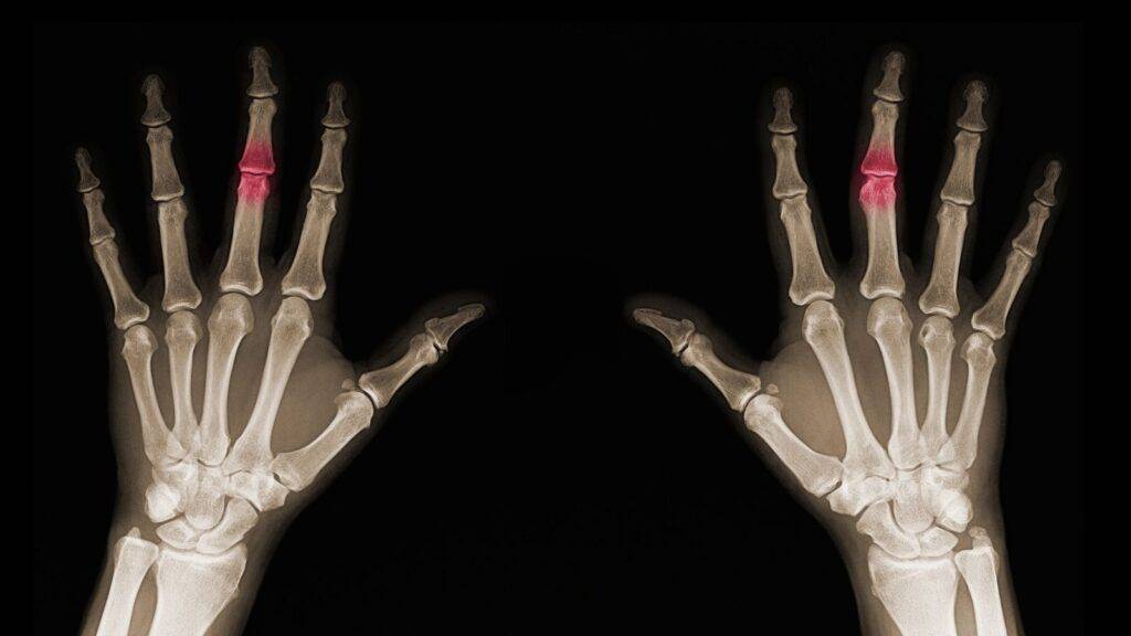 Hand injury X-ray showing fractures for hand injury compensation calculator UK assessment