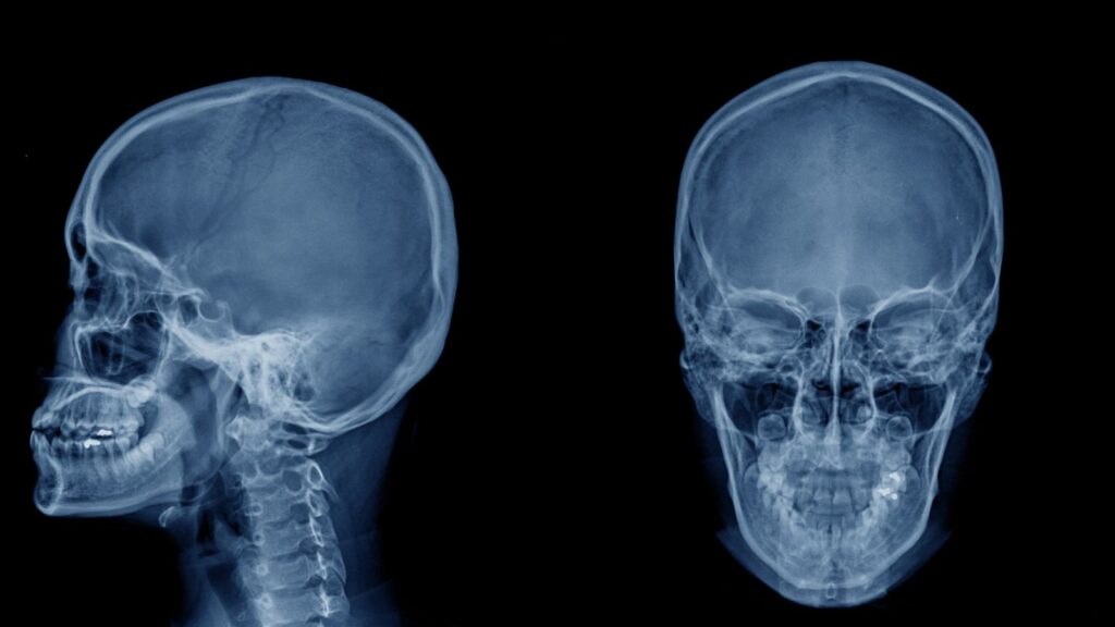 Skull X-ray imaging showing head structure for head injury compensation calculator UK 2025 assessment