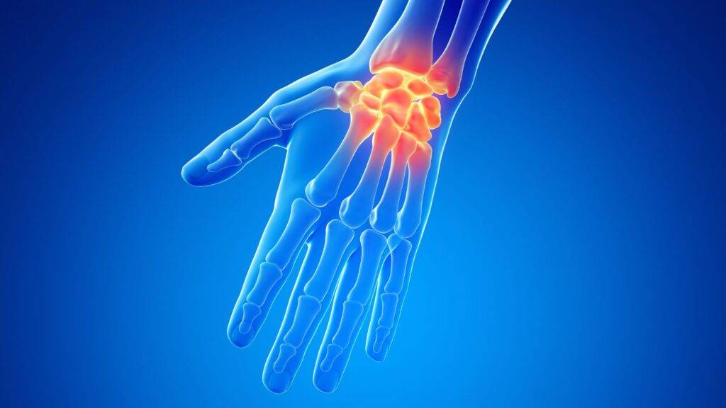 Wrist injury medical illustration showing pain area for wrist injury compensation calculator UK 2025 assessment