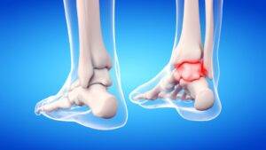 3D anatomical illustration showing ankle bone structure with red injury highlighting representing fractures and ligament damage for ankle injury compensation UK 2025 legal claims