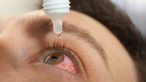 Eye drops being administered to treat visible eye injury showing redness and inflammation for eye injury compensation UK 2025 medical treatment documentation