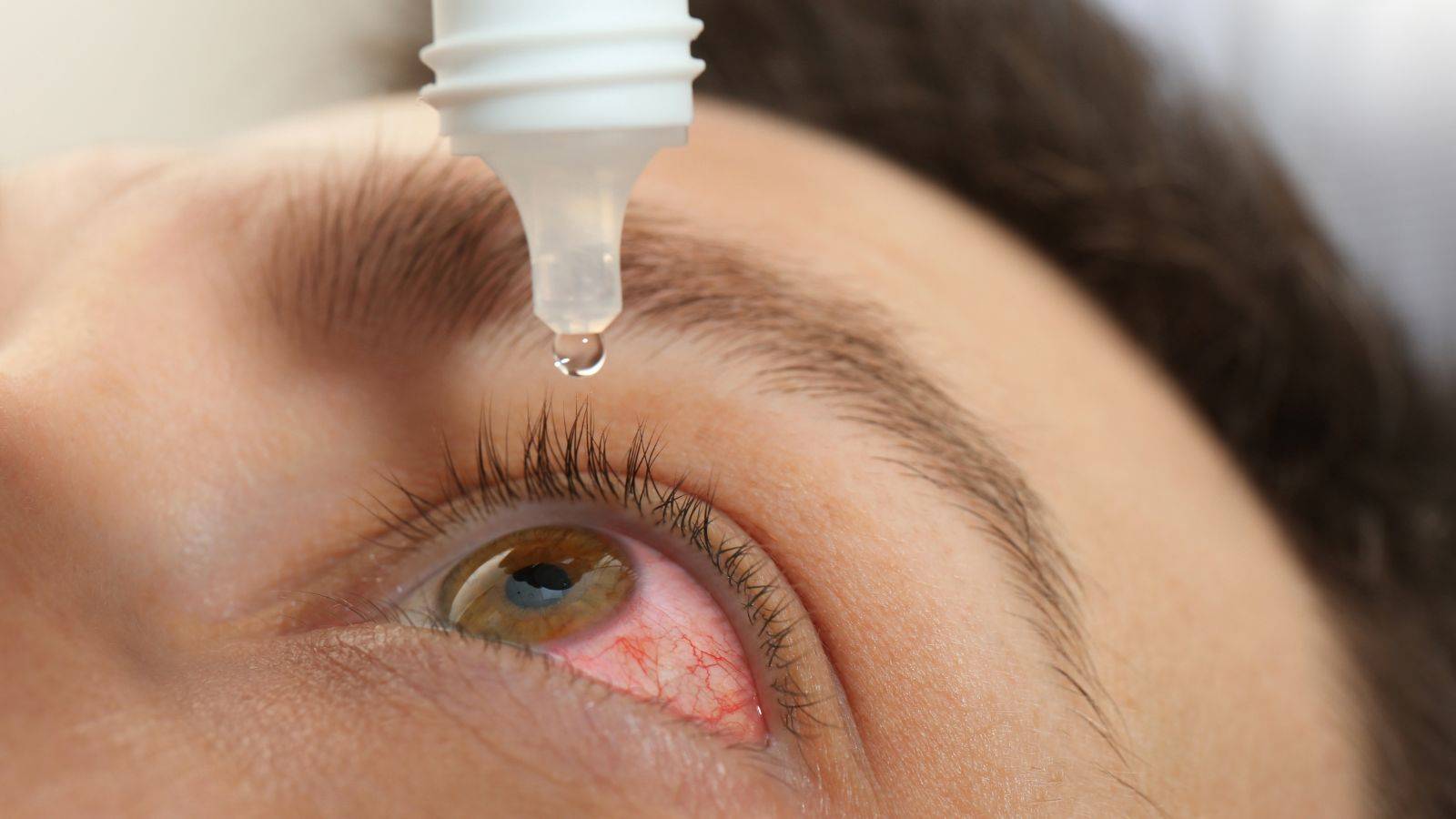 Eye drops being administered to treat visible eye injury showing redness and inflammation for eye injury compensation UK 2025 medical treatment documentation